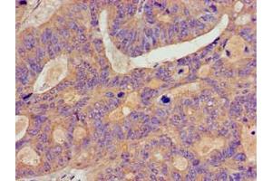 Immunohistochemistry of paraffin-embedded human colon cancer using ABIN7145766 at dilution of 1:100 (BCAR1 Antikörper  (AA 68-218))