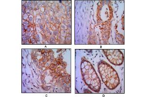 Immunohistochemical analysis of paraffin-embedded human lung cancer (A), colon cancer (B), breast cancer (C) and rectal cancer(D), using EPCAM mouse mAb with DAB staining. (EpCAM Antikörper)