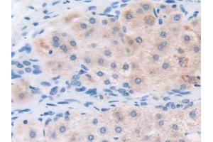 Detection of ETFb in Human Liver cancer Tissue using Polyclonal Antibody to Electron Transfer Flavoprotein Beta Polypeptide (ETFb)