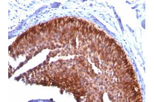 Formalin-fixed, paraffin-embedded human Bladder Carcinoma stained with CK17 Mouse Monoclonal Antibody (KRT17/778). (KRT17 Antikörper)