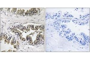 Immunohistochemistry analysis of paraffin-embedded human prostate carcinoma tissue, using GSPT1 Antibody.