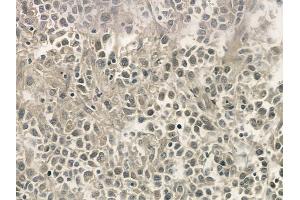 ABIN6255665 and ABIN6268972 at 1/100 staining human non-Hodgkin lymphoma by IHC-P. (Cyclin H Antikörper  (pThr315))
