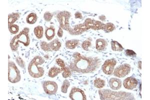 Formalin-fixed, paraffin-embedded human Breast Carcinoma stained with Calpain 1 Mouse Monoclonal Antibody (CAPN1/1530). (CAPNL1 Antikörper)