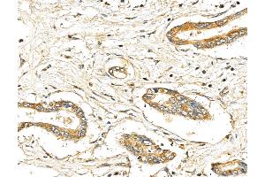 ABIN7094342 and ABIN7098389 at 1/100 staining Human pancreatic cancer by IHC-P. (LIN7C Antikörper  (Internal Region))