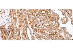 Immunohistochemistry of paraffin-embedded Human thyroid cancer tissue using MCAM Polyclonal Antibody at dilution of 1:40(x200) (MCAM Antikörper)