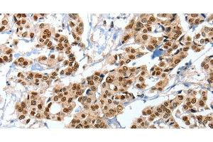 Immunohistochemistry of paraffin-embedded Human breast cancer tissue using ANXA10 Polyclonal Antibody at dilution 1:35 (Annexin a10 Antikörper)