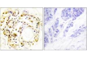 Immunohistochemistry analysis of paraffin-embedded human breast carcinoma, using ERK3 (Phospho-Ser189) Antibody. (MAPK6 Antikörper  (pSer189))