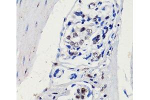 Immunohistochemistry of paraffin-embedded Human gastric cancer using p27 KIP 1 Polyclonal Antibody at dilution of 1:100 (40x lens). (CDKN1B Antikörper)