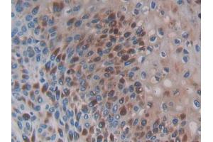 IHC-P analysis of Human Skin cancer Tissue, with DAB staining. (CCL3L1 Antikörper  (AA 1-93))