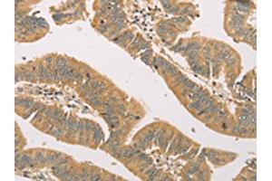 The image on the left is immunohistochemistry of paraffin-embedded Human colon cancer tissue using ABIN7131118(SNAP91 Antibody) at dilution 1/20, on the right is treated with fusion protein. (SNAP91 Antikörper)