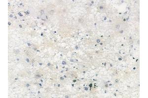 ABIN6255723 and ABIN6267298 at 1/100 staining human astrocytoma by IHC-P.