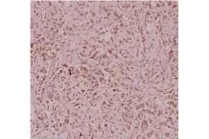 Immunohistochemistry analysis of Defensin alpha-3 Antibody in paraffin-embedded human breast carcinoma tissue at 1/100.