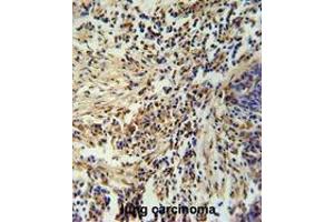 ZNF720 Antibody (Center) immunohistochemistry analysis in formalin fixed and paraffin embedded human lung carcinoma followed by peroxidase conjugation of the secondary antibody and DAB staining. (ZNF720 Antikörper  (Middle Region))