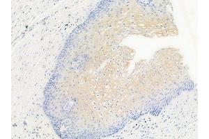 ABIN6256156 and ABIN6267546 at 1/100 staining human cervical carcinoma by IHC-P. (VASP Antikörper  (pSer157))