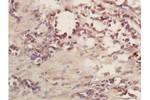 Formalin-fixed and paraffin embedded human lung carcinoma labeled with Rabbit Anti-CD101 Polyclonal Antibody, Unconjugated (ABIN2172703) at 1:200 followed by conjugation to the secondary antibody and DAB staining (CD101 Antikörper  (AA 51-150))