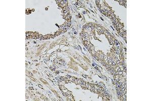 Immunohistochemistry of paraffin-embedded human prostate using TMC1 antibody (ABIN6134923, ABIN6149240, ABIN6149242 and ABIN6224704) at dilution of 1:100 (40x lens). (TMC1 Antikörper  (AA 600-700))