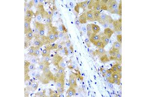 Immunohistochemistry of paraffin-embedded human liver cancer using TIRAP antibody (ABIN5971003) at dilution of 1/200 (40x lens). (TIRAP Antikörper)