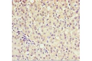 Immunohistochemistry of paraffin-embedded human liver cancer using ABIN7143586 at dilution of 1:100 (AKR7A2 Antikörper  (AA 100-359))