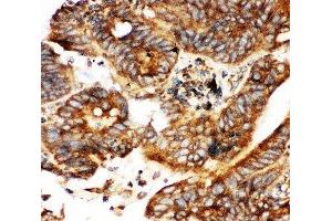 IHC-P testing of human intestinal cancer tissue (CALB1 Antikörper  (AA 2-175))