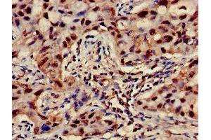 Immunohistochemistry of paraffin-embedded human lung cancer using ABIN7144852 at dilution of 1:100 (ATP5F1D Antikörper  (AA 32-158))