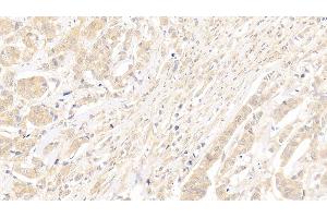 Detection of Surv in Human Breast cancer Tissue using Polyclonal Antibody to Survivin (Surv) (Survivin Antikörper  (AA 1-142))