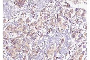 ABIN6267469 at 1/100 staining human breast carcinoma tissue sections by IHC-P.
