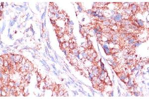 Immunohistochemistry of paraffin-embedded Human colon carcinoma using RPL24 Polyclonal Antibody at dilution of 1:100 (40x lens). (RPL24 Antikörper)