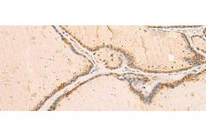 Immunohistochemistry of paraffin-embedded Human thyroid cancer tissue using IP6K3 Polyclonal Antibody at dilution of 1:50(x200) (IP6K3 Antikörper)