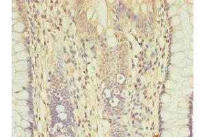Immunohistochemistry of paraffin-embedded human colon cancer using ABIN7149384 at dilution of 1:100 (AGBL2 Antikörper  (AA 10-270))