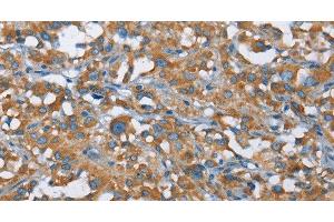 Immunohistochemistry of paraffin-embedded Human thyroid cancer tissue using KLF7 Polyclonal Antibody at dilution 1:40 (KLF7 Antikörper)
