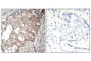 Immunohistochemical analysis of paraffin-embedded human breast carcinoma tissue using Shc1(Phospho-Tyr427) Antibody(left) or the same antibody preincubated with blocking peptide(right). (SHC1 Antikörper  (pTyr427))