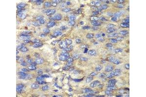 Immunohistochemistry of paraffin-embedded Human liver cancer using SDHA Polyclonal Antibody at dilution of 1:100 (40x lens). (SDHA Antikörper)