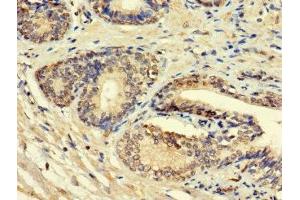 Immunohistochemistry of paraffin-embedded human prostate cancer using ABIN7156008 at dilution of 1:100 (HSD11B1L Antikörper  (AA 17-87))