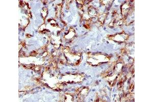 IHC staining of angiosarcoma with PECAM-1 antibody (C31. (CD31 Antikörper)