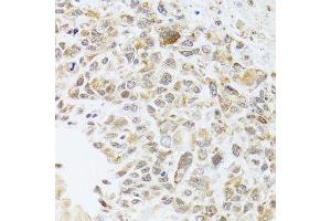 Immunohistochemistry of paraffin-embedded human lung cancer using RNASEL antibody. (RNASEL Antikörper  (AA 472-741))