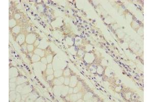 Immunohistochemistry of paraffin-embedded human colon cancer using ABIN7171349 at dilution of 1:100 (TCTA Antikörper  (AA 62-103))