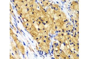 Immunohistochemistry of paraffin-embedded Human lung cancer using CAPG Polyclonal Antibody at dilution of 1:100 (40x lens). (CAPG Antikörper)