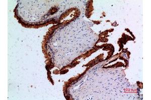 Immunohistochemistry (IHC) analysis of paraffin-embedded Human Prostatic Cancer, antibody was diluted at 1:100. (Angiopoietin 1 Antikörper  (N-Term))