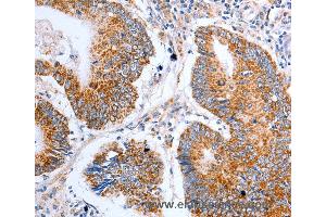 Immunohistochemistry of Human liver cancer using CLDN10 Polyclonal Antibody at dilution of 1:50 (CLDN10 Antikörper)