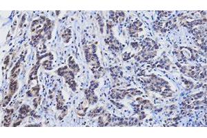Paraffin embedded sections of human gastric cancer tissue were incubated with RBP4 monoclonal antibody, clone AT2B4 (Cat # MAB3211 ; 1 : 25) for 2 hours at room temperature. (RBP4 Antikörper  (AA 19-201))