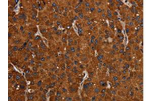 The image on the left is immunohistochemistry of paraffin-embedded Human liver cancer tissue using ABIN7192423(SLC22A12 Antibody) at dilution 1/20, on the right is treated with synthetic peptide. (SLC22A12 Antikörper)