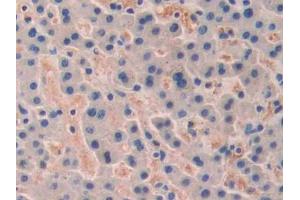 DAB staining on IHC-P; Samples: Human Liver cancer Tissue (TRF1 Antikörper  (AA 148-428))