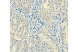 Immunohistochemistry of paraffin-embedded human endometrial cancer using ABIN7176084 at dilution of 1:100 (ZMAT5 Antikörper  (AA 1-170))