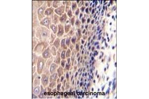 CCDC97 Antibody (C-term) (ABIN655301 and ABIN2844887) immunohistochemistry analysis in formalin fixed and paraffin embedded human esophageal carcinoma followed by peroxidase conjugation of the secondary antibody and DAB staining. (CCDC97 Antikörper  (C-Term))