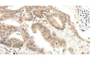 Immunohistochemistry of paraffin-embedded Human colon cancer tissue using RRAD Polyclonal Antibody at dilution 1:50 (RRAD Antikörper)