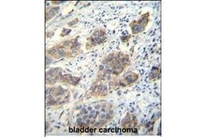 CDH24 Antibody (N-term) (ABIN656094 and ABIN2845437) immunohistochemistry analysis in formalin fixed and paraffin embedded human bladder carcinoma followed by peroxidase conjugation of the secondary antibody and DAB staining. (Cadherin 24 Antikörper  (N-Term))
