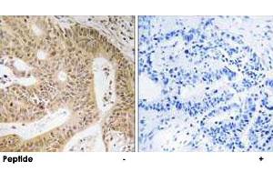 Immunohistochemistry analysis of paraffin-embedded human colon carcinoma tissue using DAP polyclonal antibody . (DAP Antikörper)