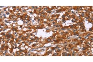 Immunohistochemistry of paraffin-embedded Human thyroid cancer tissue using GPHN Polyclonal Antibody at dilution 1:30 (Gephyrin Antikörper)