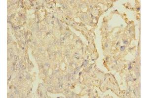Immunohistochemistry of paraffin-embedded human lung cancer using ABIN7158886 at dilution of 1:100 (MARCO Antikörper  (AA 421-520))