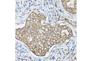Immunohistochemistry of paraffin-embedded human breast cancer using OL Rabbit pAb (1671) at dilution of 1:100 (40x lens). (OLA1 Antikörper  (AA 297-396))